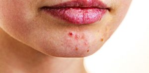 Lire la suite à propos de l’article Quel est le lien entre le SIBO et l’acné ?