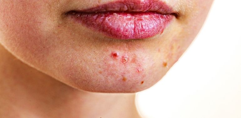 You are currently viewing Quel est le lien entre le SIBO et l’acné ?